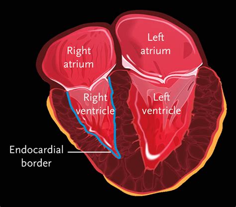 increased right ventricular cavity size.